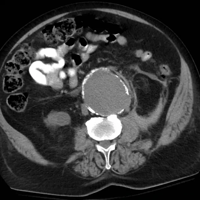Axial abdominal CT scan showing an abdominal aortic aneurysm.